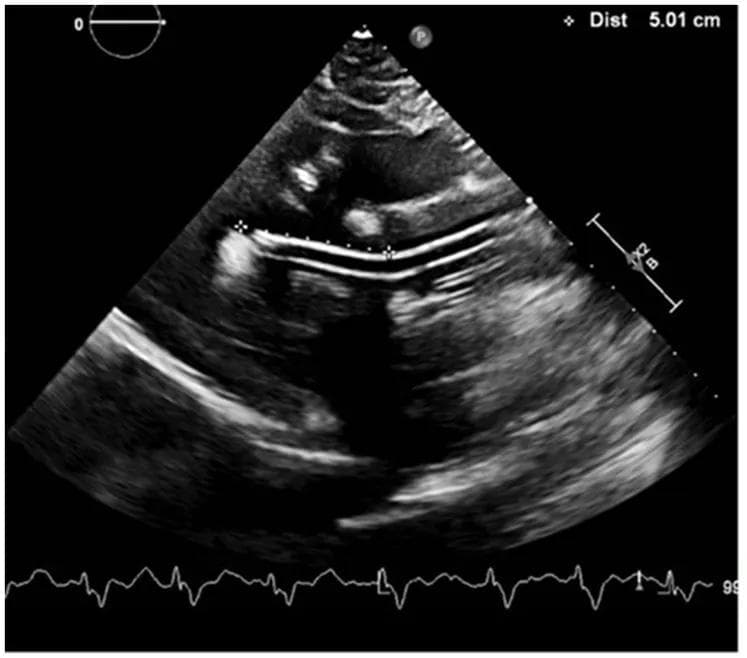 echocardiography PLAX Impala 5.5 mechanical cardiac support